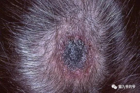耳中取出活体猫螨虫