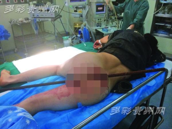 男子花17万屁股整形后肛门功能受损