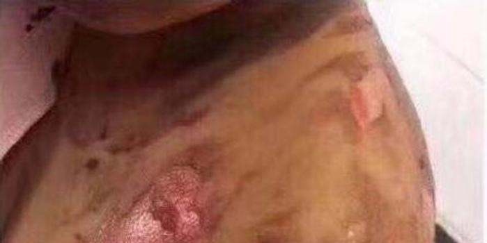 学生出操被地面烫伤
