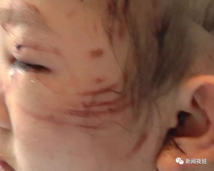 女童被狗扑咬受伤