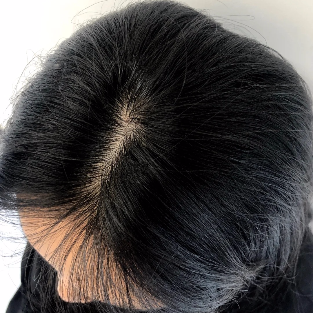 震惊！女子因脱发30岁被误认为奶奶，背后真相令人心酸